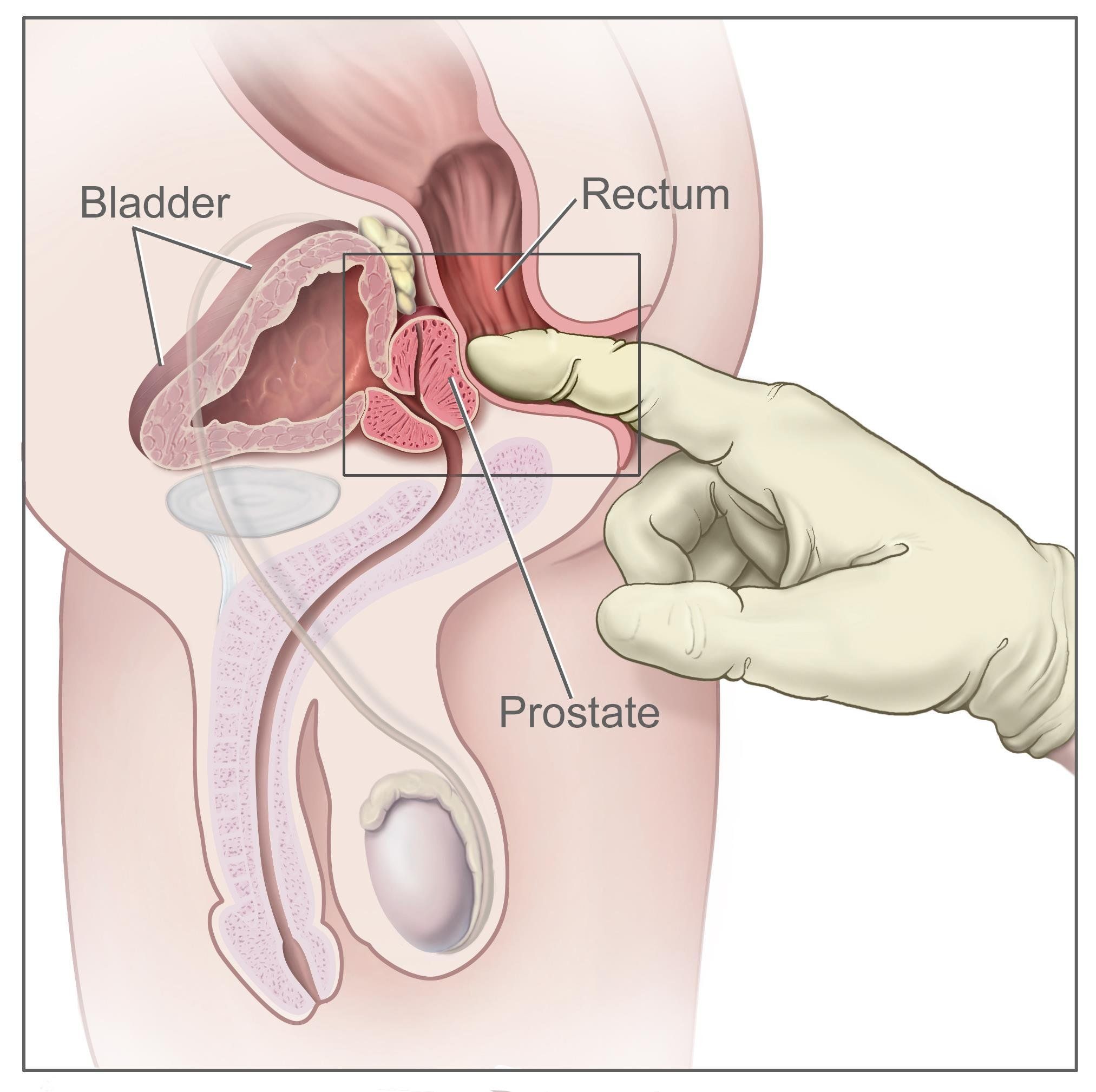 Sgt. C. reccomend Causes of anal b leeding