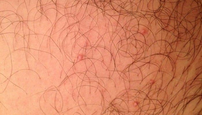 Sex with internal vaginal warts