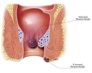 best of Anal b leeding Causes of