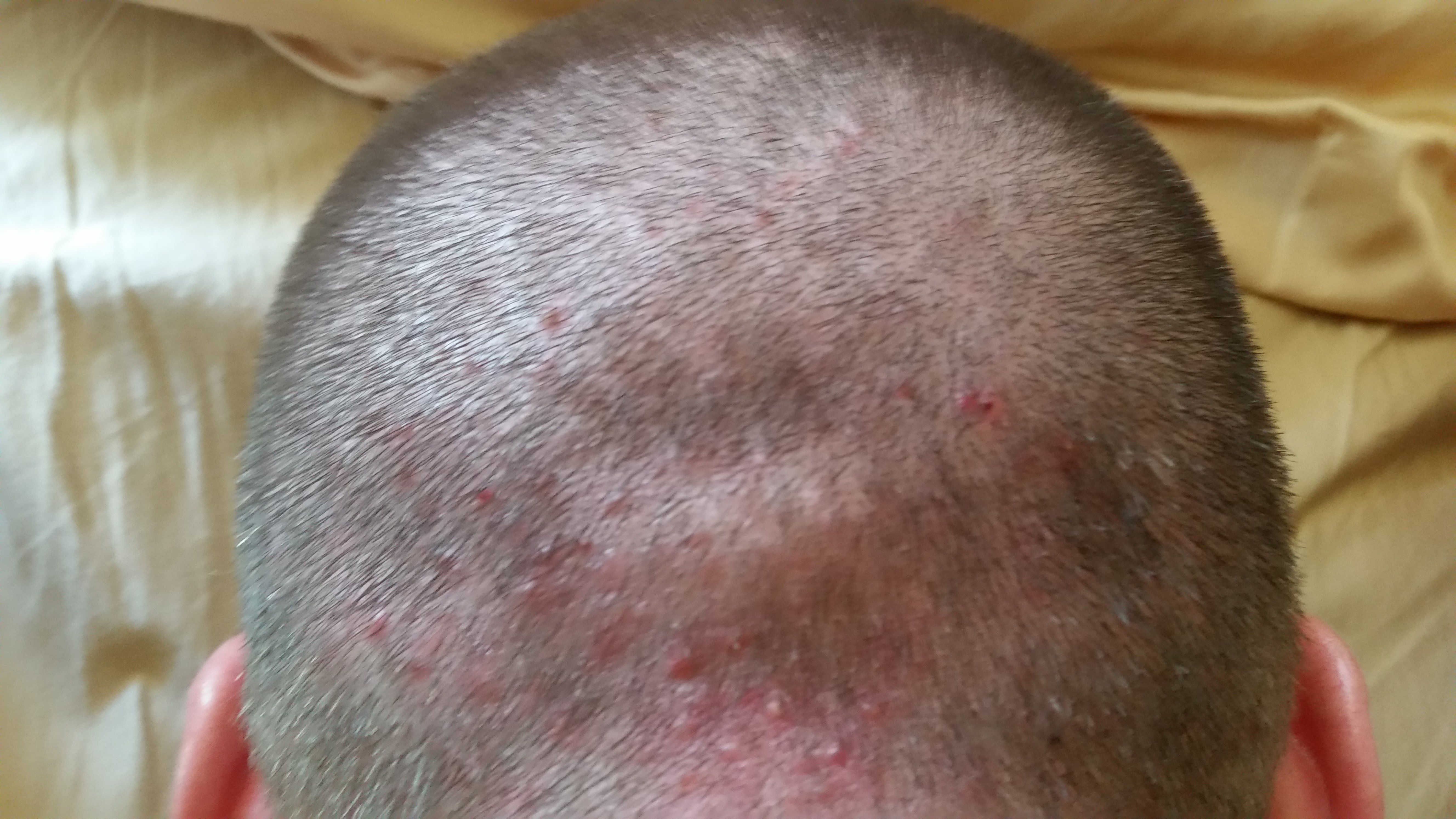 best of Head folliculitis Shaved cures