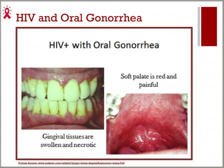 Lumber reccomend Oral sex and gonorrhea