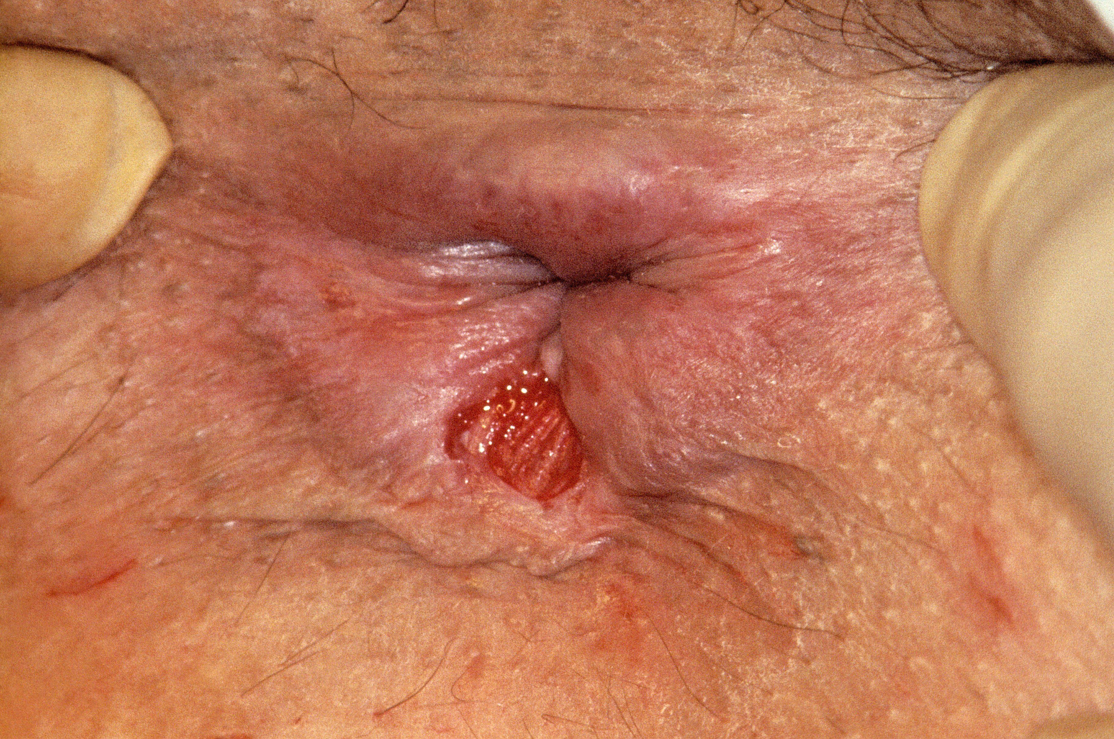 The I. reccomend Anal rupture after sex