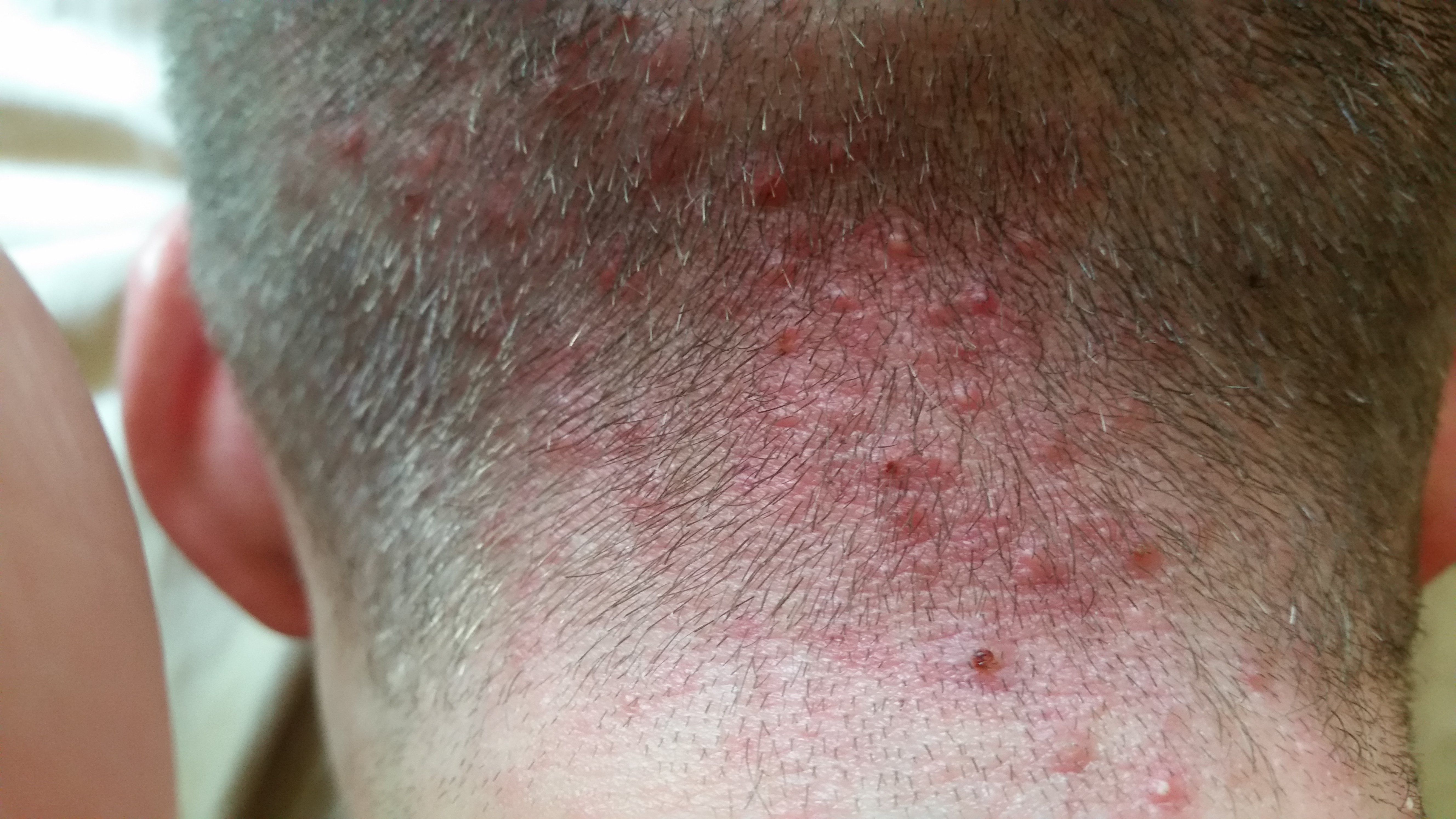 Target reccomend Shaved head cures folliculitis