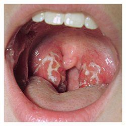 Oral sex and gonorrhea