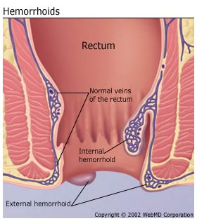 best of Anal b leeding Causes of