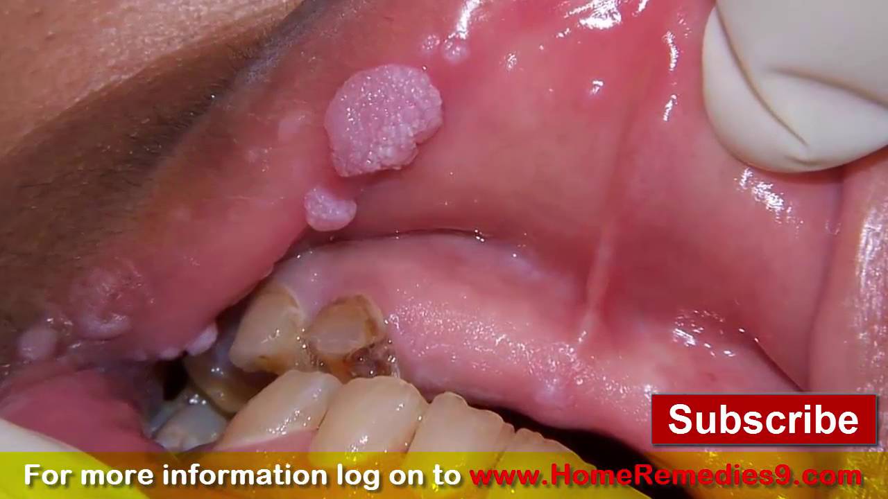 Sex with internal vaginal warts