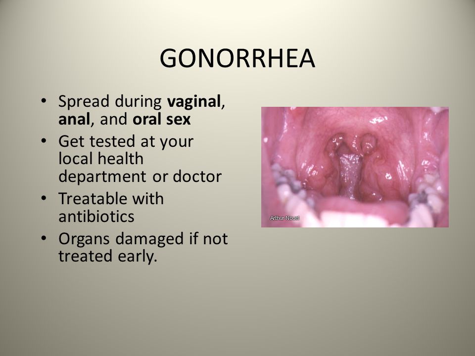 Oral sex and gonorrhea