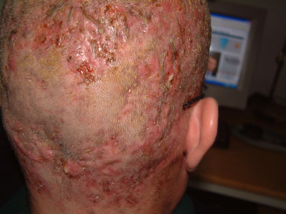 Shaved head cures folliculitis