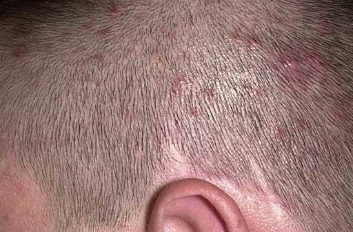 Vice reccomend Shaved head cures folliculitis